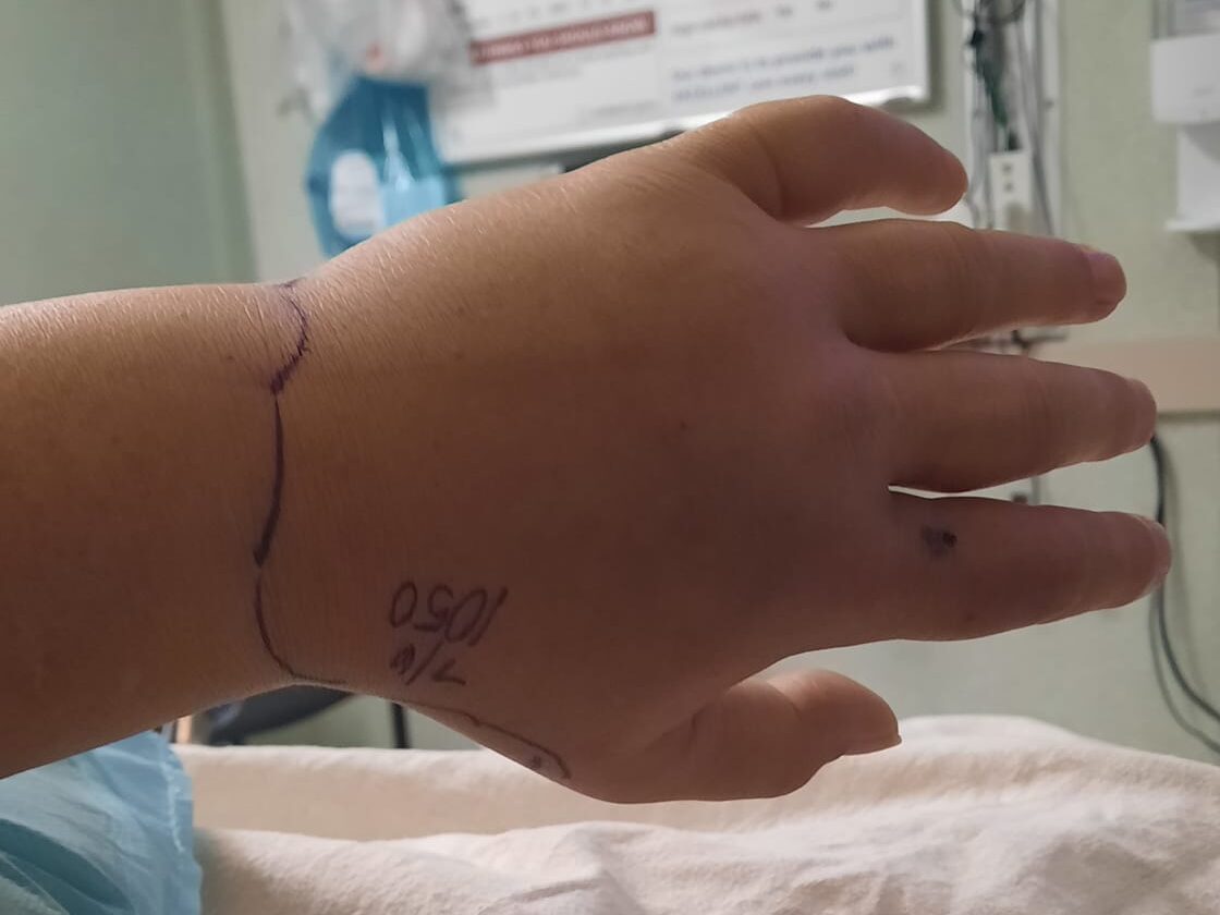 A swollen hand that had been bitten by a venomous copperhead snake
